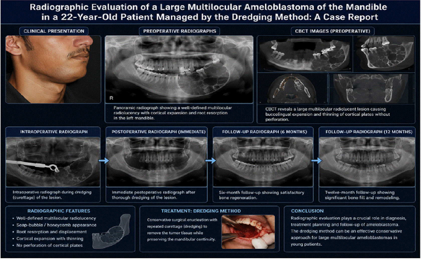 Radiographic Evaluation of a Large Multilocular Ameloblastoma of the Mandible in a 22-Year-Old Patient Managed by the Dredging Method A Case Report